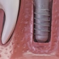 Why dental implants expensive?