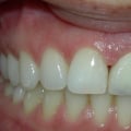 How do you keep veneers from falling off?