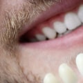 Revamp Your Smile With Dental Veneers And Teeth Whitening In Sydney