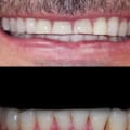 Can you get veneers for your bottom teeth?