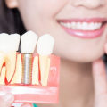Can you keep veneers forever?