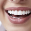 Benefits Of Investing In Quality Dental Veneers In Borger, TX