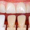 Can veneers be done twice?