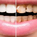 How long can you keep porcelain veneers?