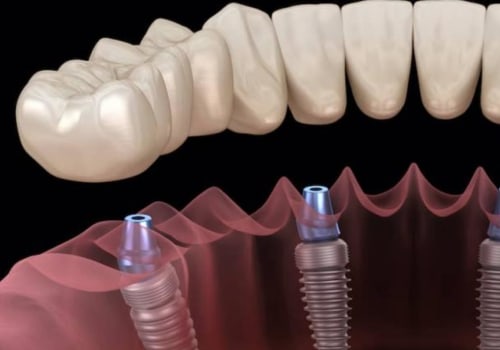 What are the most durable dental implants?