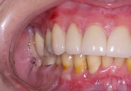 Do veneers permanently damage teeth?