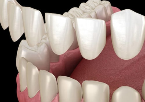 Transform Your Smile With Dental Porcelain Veneers In Sydney