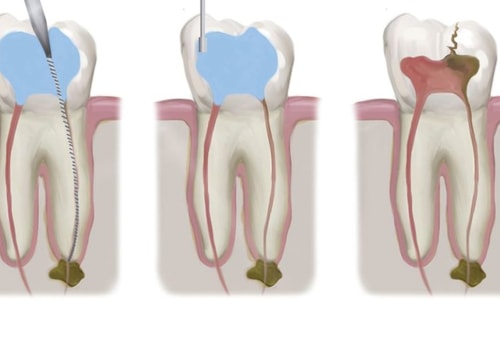 Dental Veneers And Emergency Root Canal Treatment In London: What To Expect