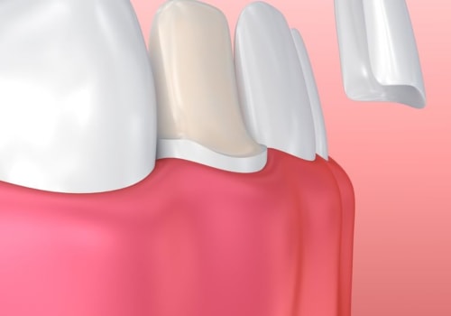 Why Porcelain Veneers Are The Perfect Solution For A Beautiful Smile In San Antonio