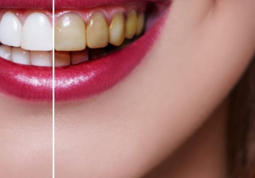 How much does a top row of veneers cost?