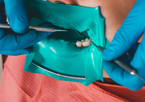 The Benefits Of Choosing A Dental Clinic With Dental Veneers Expertise In Woden