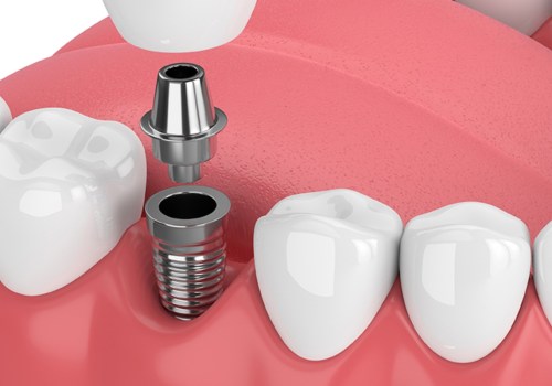 What dental veneers?