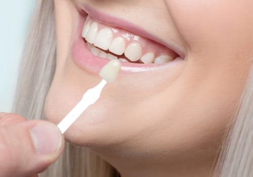 How often should veneers be replaced?