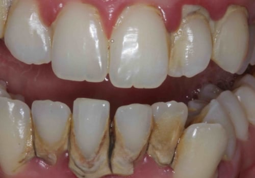 What problems do veneers cause?