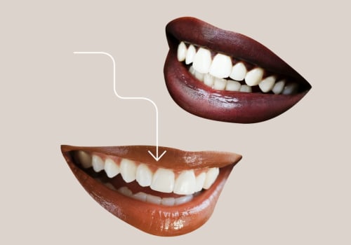 Cosmetic Treatments In Dripping Springs: A Guide To Understanding Dental Veneers And Their Uses