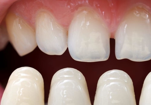 How long are veneers supposed to last?