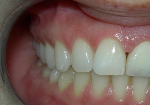 Why are veneers so painful?