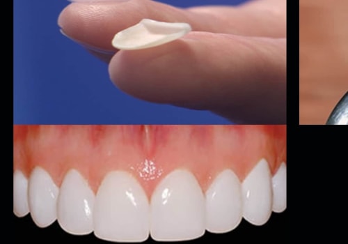 How often do you need veneers redone?