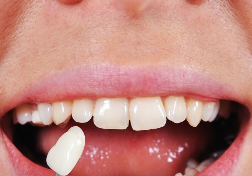 What happens to the teeth under veneers?
