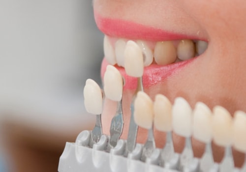 The Ultimate Smile Upgrade: Porcelain Veneers In Spring Branch, TX