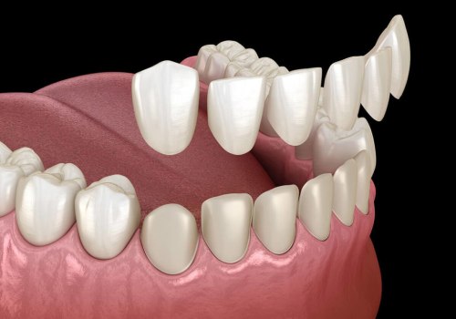 How long does it take for a veneer to settle?