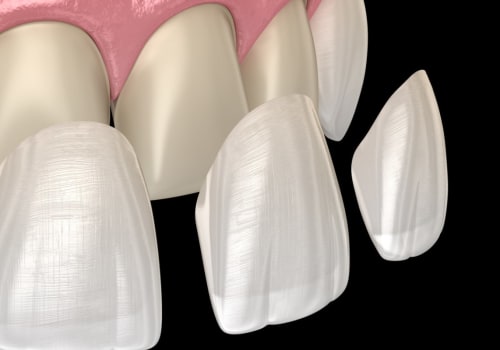 Why Dental Veneers In Waco Are Worth The Investment