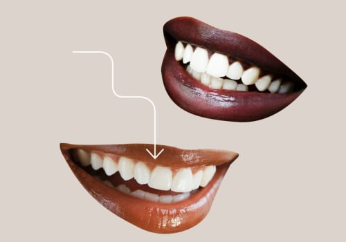 Everything You Need To Consider When Thinking About Getting Dental Veneers In Georgetown And Austin