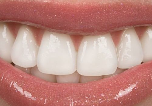 Dental Veneers In Spring, TX: A Guide To Transform Your Smile With Porcelain