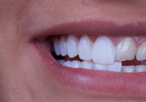 Why dental veneers?