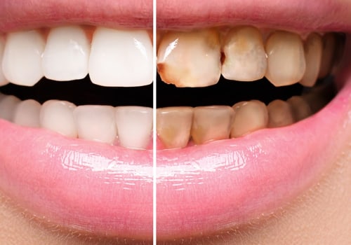 How many dental visits do you need for veneers?