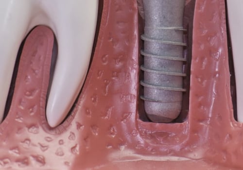 Why dental implants expensive?