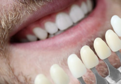 Revamp Your Smile With Dental Veneers And Teeth Whitening In Sydney