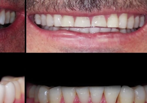 Can you get veneers for your bottom teeth?