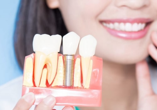 Can you keep veneers forever?