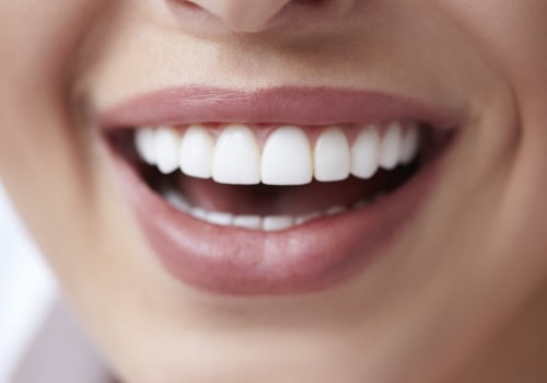 Benefits Of Investing In Quality Dental Veneers In Borger, TX