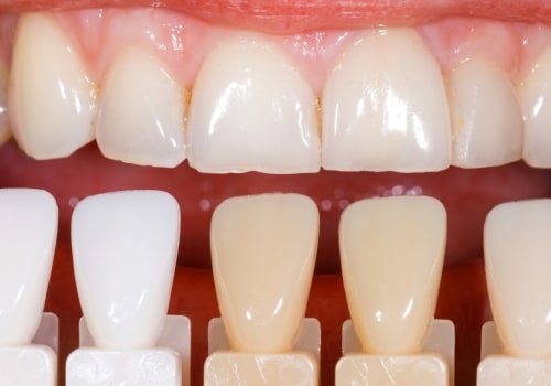 Can veneers be done twice?